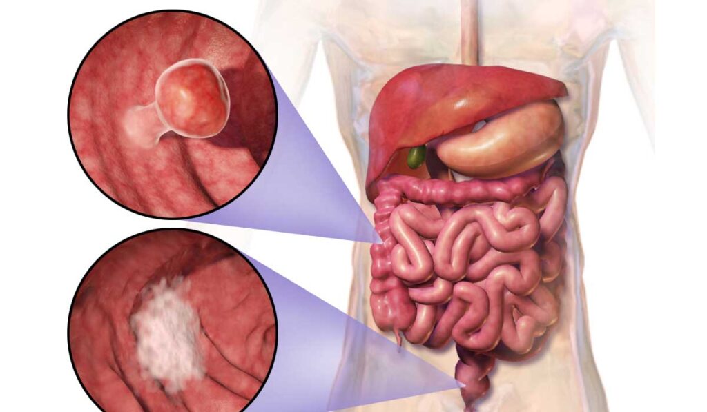 कम उम्र में भी कोलोरेक्टल कैंसर की समस्या : डॉ. अमित सहरावत... नए इलाज के तरीकों और इम्यूनोथेरेपी जैसी तकनीकों में प्रगति से मरीजों को दीर्घकालिक राहत प्रदान की जा सकती है। इसके अलावा, कैंसर की रोकथाम और शुरुआती निदान पर भी अधिक ध्यान देना चाहिए। एम्स ऋषिकेश के कैंसर रोग विशेषज्ञ एवं सह-आचार्य डॉ. अमित सहरावत से #अंकित तिवारी खास बातचीत)