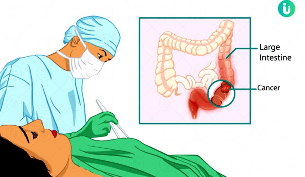 कम उम्र में भी कोलोरेक्टल कैंसर की समस्या : डॉ. अमित सहरावत... नए इलाज के तरीकों और इम्यूनोथेरेपी जैसी तकनीकों में प्रगति से मरीजों को दीर्घकालिक राहत प्रदान की जा सकती है। इसके अलावा, कैंसर की रोकथाम और शुरुआती निदान पर भी अधिक ध्यान देना चाहिए। एम्स ऋषिकेश के कैंसर रोग विशेषज्ञ एवं सह-आचार्य डॉ. अमित सहरावत से #अंकित तिवारी खास बातचीत)