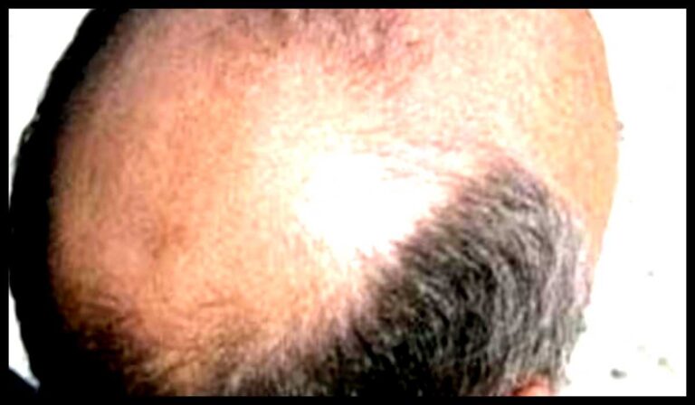 jhadte-baal-atmahatya