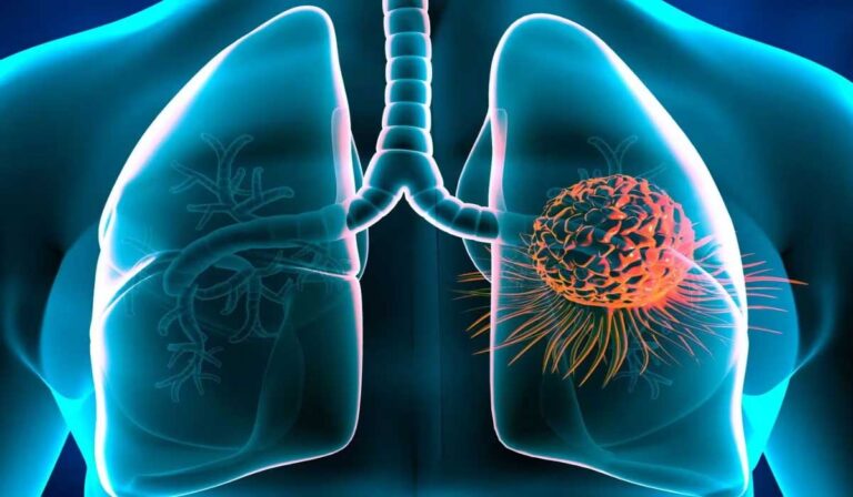 lung-cancer